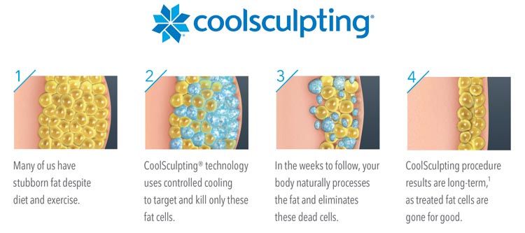 CoolSculpting_beauty_modnialmanah