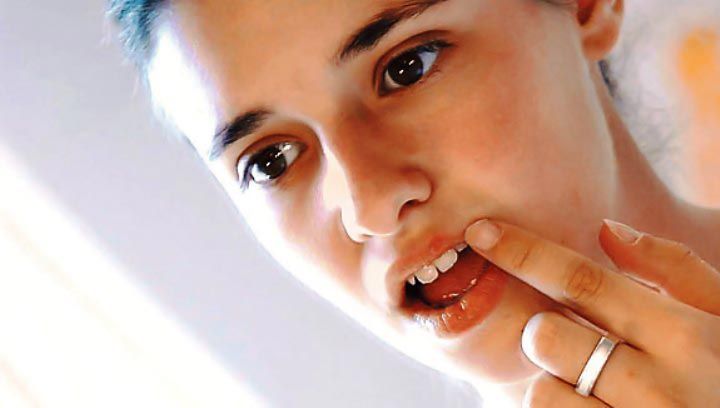 herpes-modnialmanah-zdravlje-zdrav-život