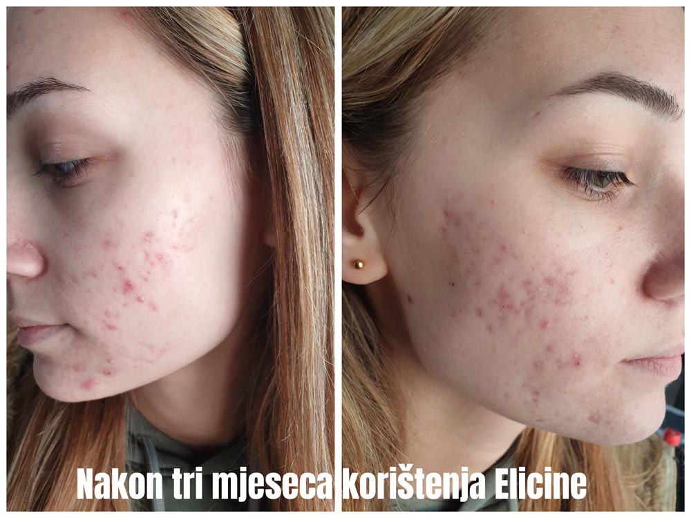 beauty-elicina-koža-njega-akne-modnialmanah
