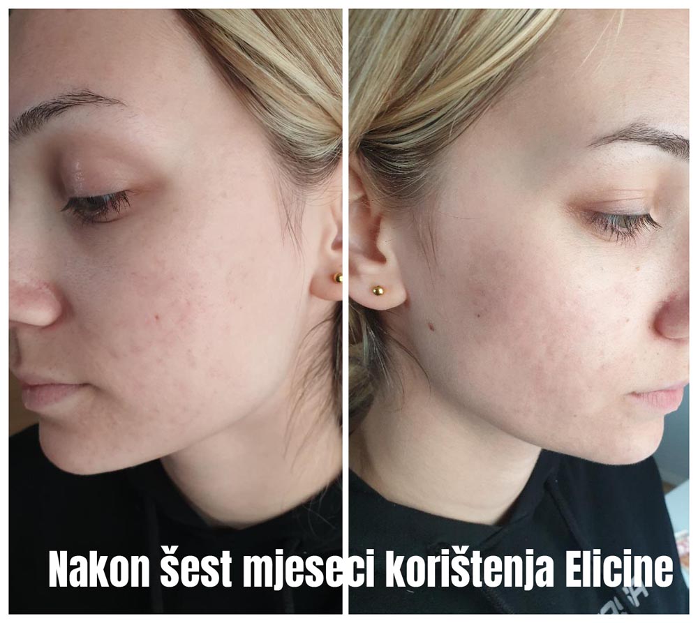 beauty-elicina-koža-njega-akne-modnialmanah