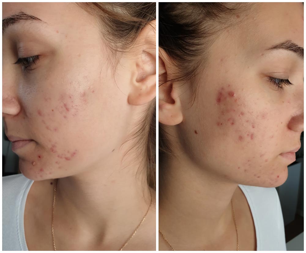 beauty-elicina-koža-njega-akne-modnialmanah