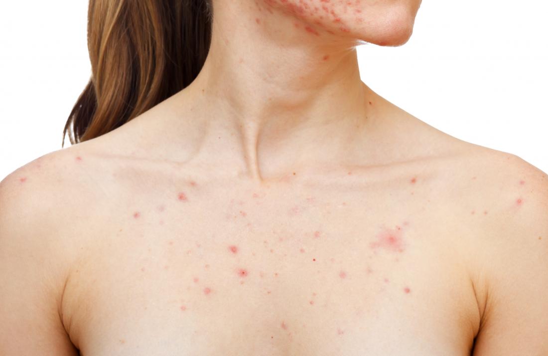 beauty-ljepota-prištići-modnialmanah-prištićima