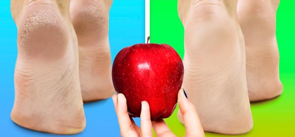 beauty-zadebljale-pete-koža-stopala-modnialmanah