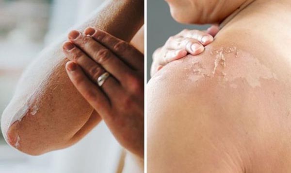 koža-beauty-ljuštenje-skin-modnialmanah