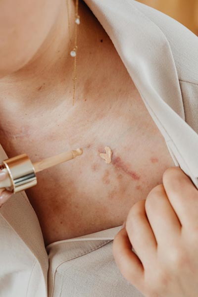 beauty-ožiljci-kako-sakriti-ožiljke-šminkom-modnialmanah